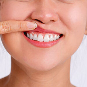 A woman displaying gum recession, a common sign of gingivitis.