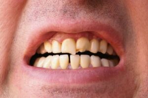 A man with visibly chipped and cracked teeth.