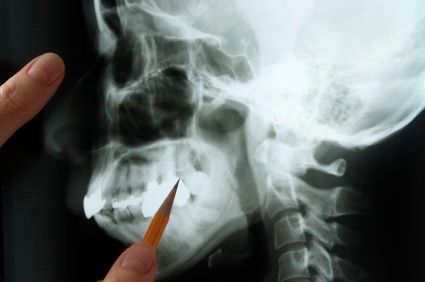 A jawbone being examined by a dentist for TMJ issues.