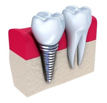 A graphic image of a dental implant after jawbone installation.
