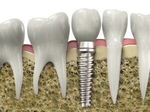 A graphic image of a dental implant embedded in jawbone.